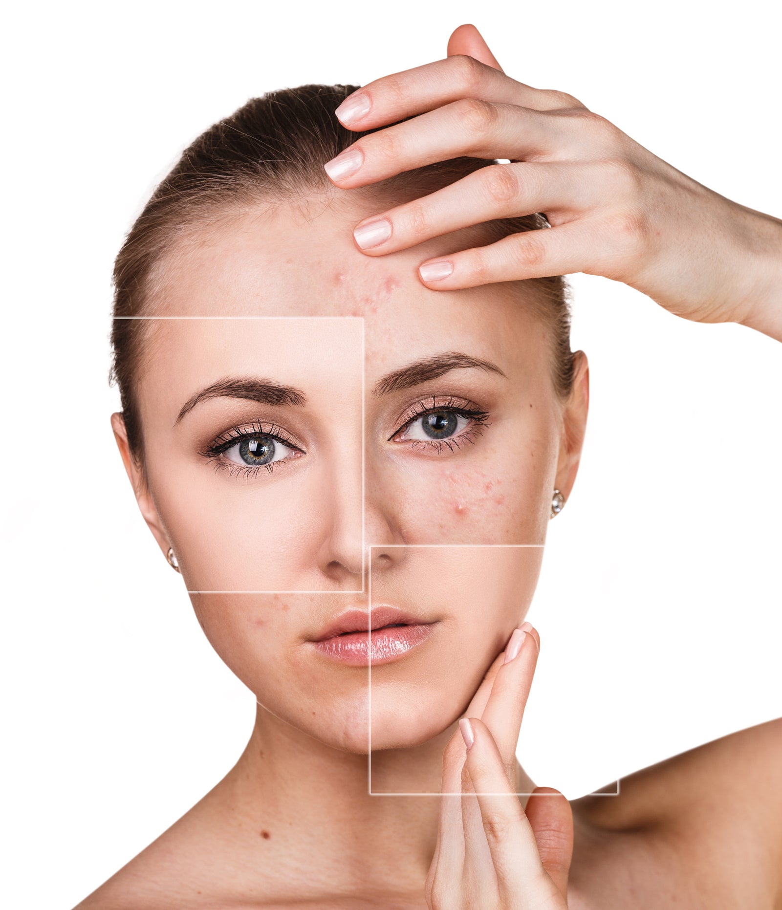 Improve your skin when endometriosis is the trigger.