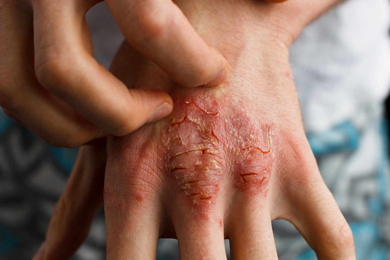 Why does Autumn cause Itchy, Dry Skin