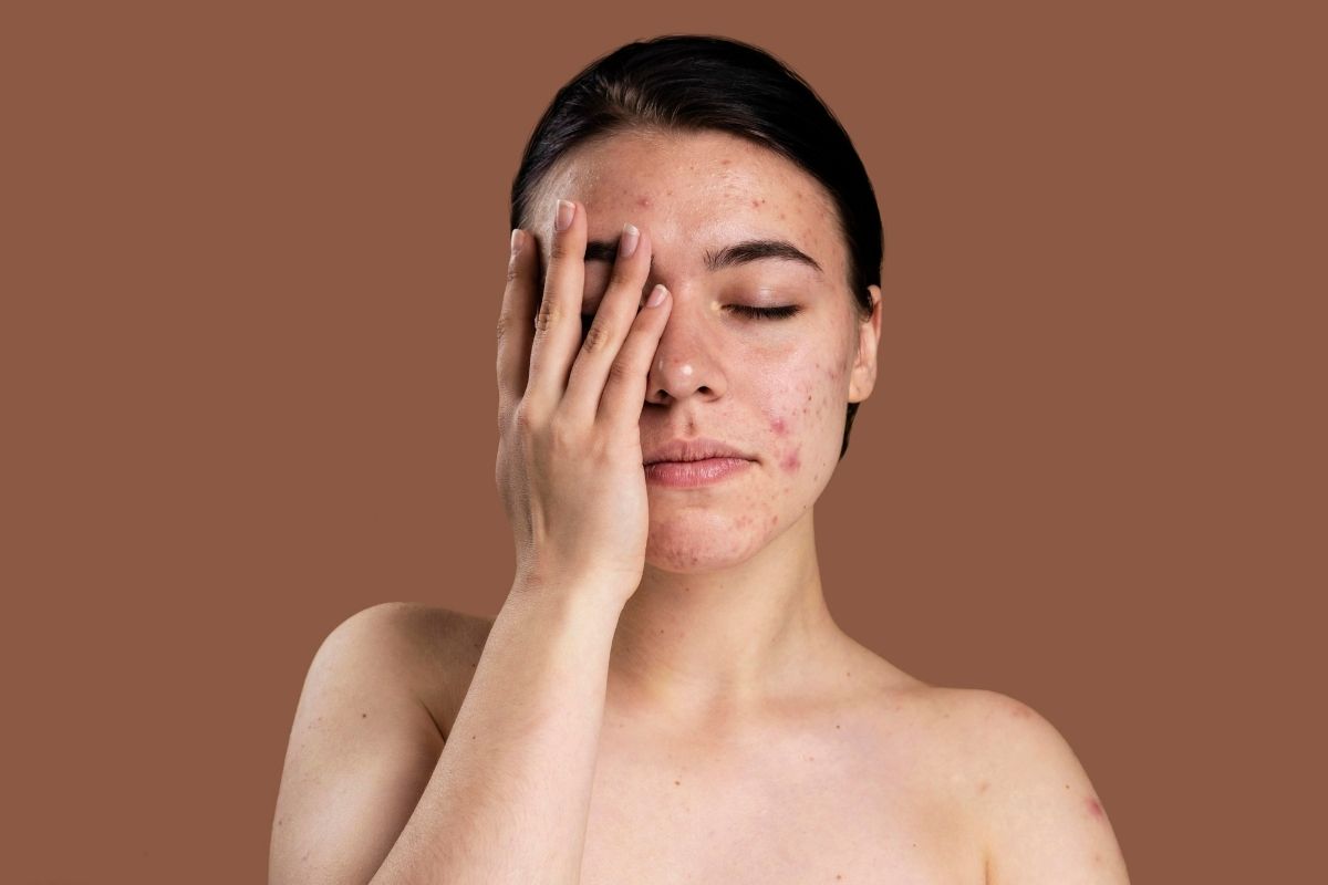 Best skin care solutions for acne and acne scarring