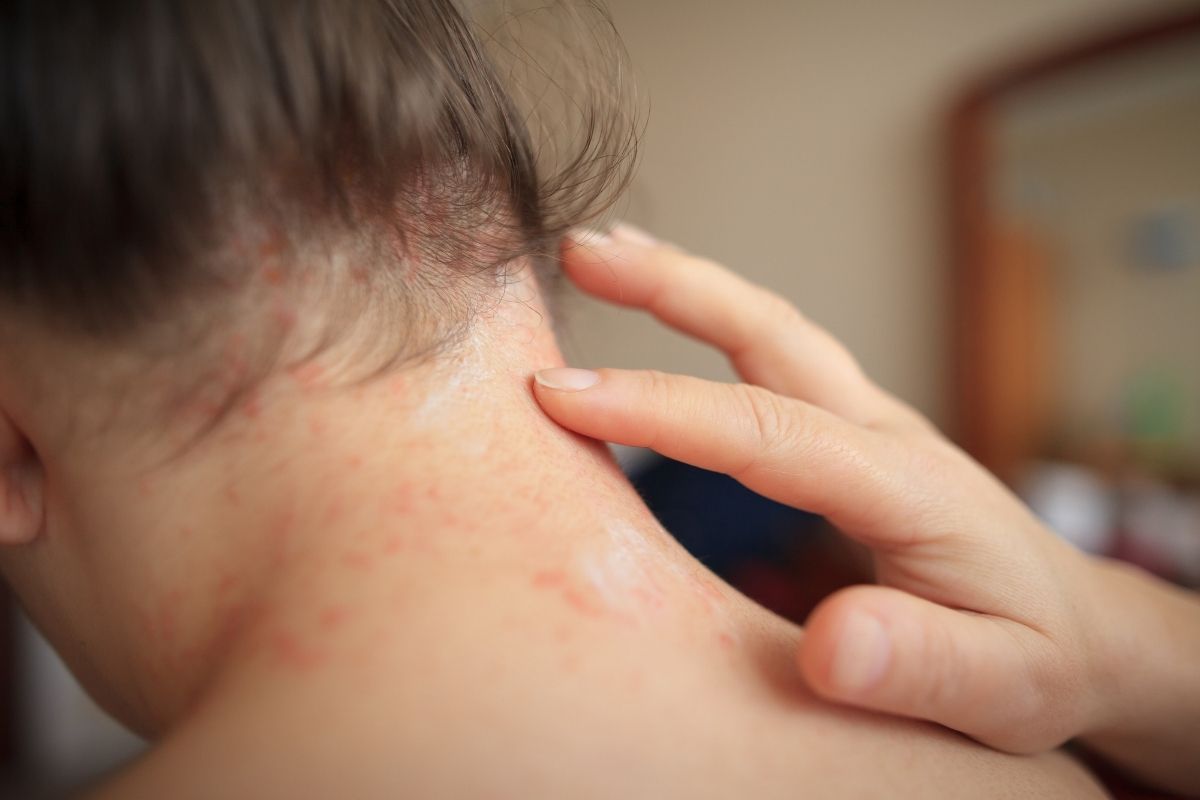 Psoriasis rash - frequently asked questions