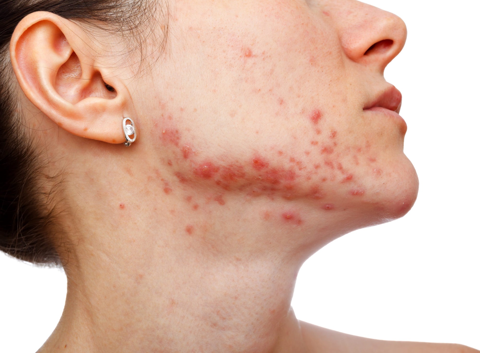 3 Tips you need to know to manage acne that's caused by PCOS.