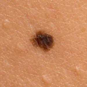 Are you keeping an eye on your Moles?