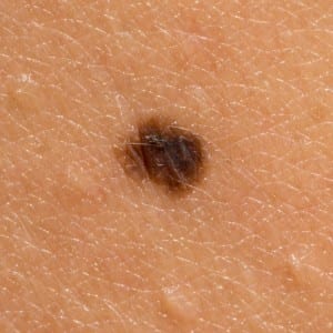 Are you keeping an eye on your Moles?