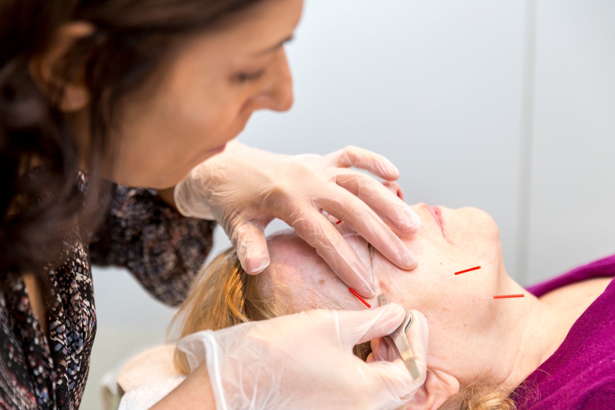 Cosmetic Acupuncture Facials:  The newest facial to hit the western world