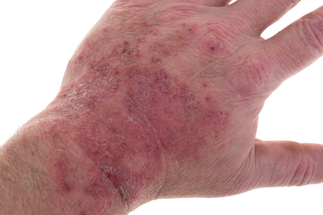 Nutrition for Eczema: A Practical Guide to Supporting Skin Health from Within