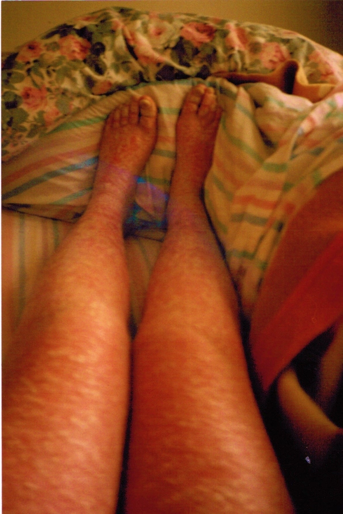 “My father/mother/friend/sibling has psoriasis, what do you recommend?”