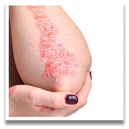 5 things you should do when managing psoriasis and eczema.