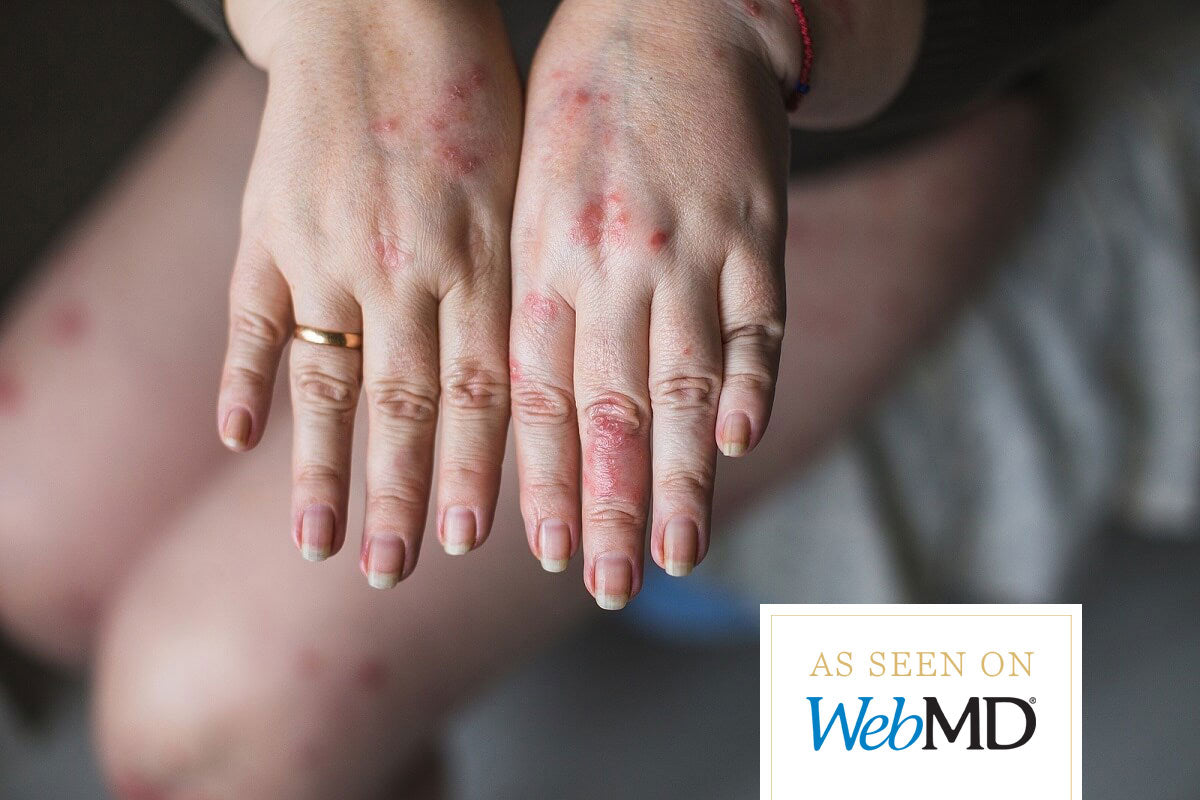 How I got featured on WebMD for Psoriasis