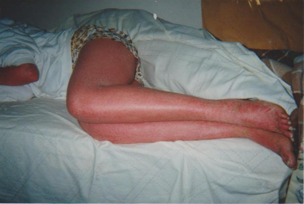 Exposed my Psoriasis - Why did I put myself out there?
