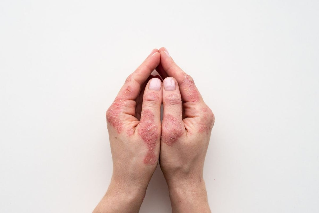 Natural Approaches to Managing Psoriasis and Eczema