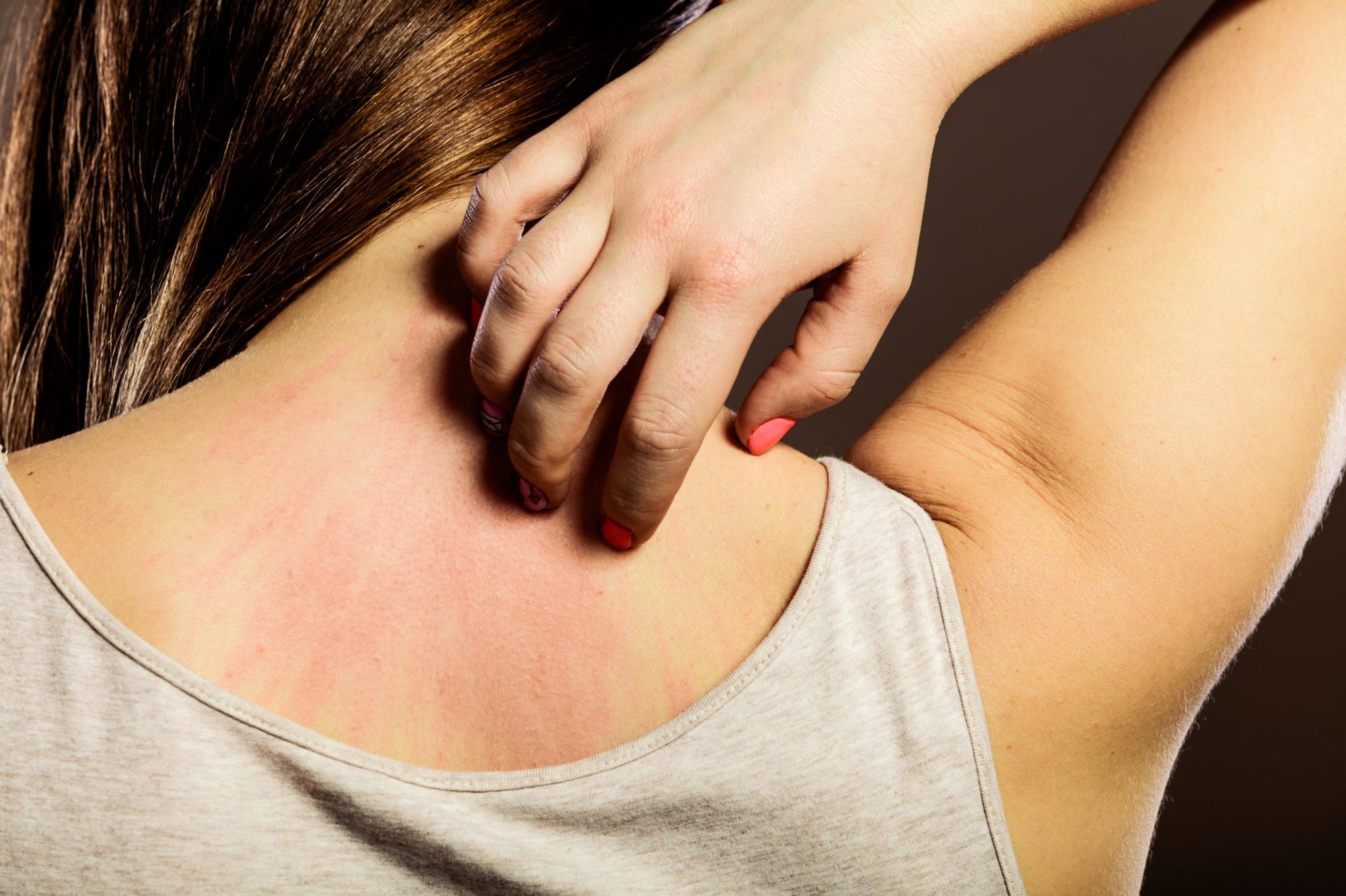 Is Autumn Making Your Psoriasis More Dry?