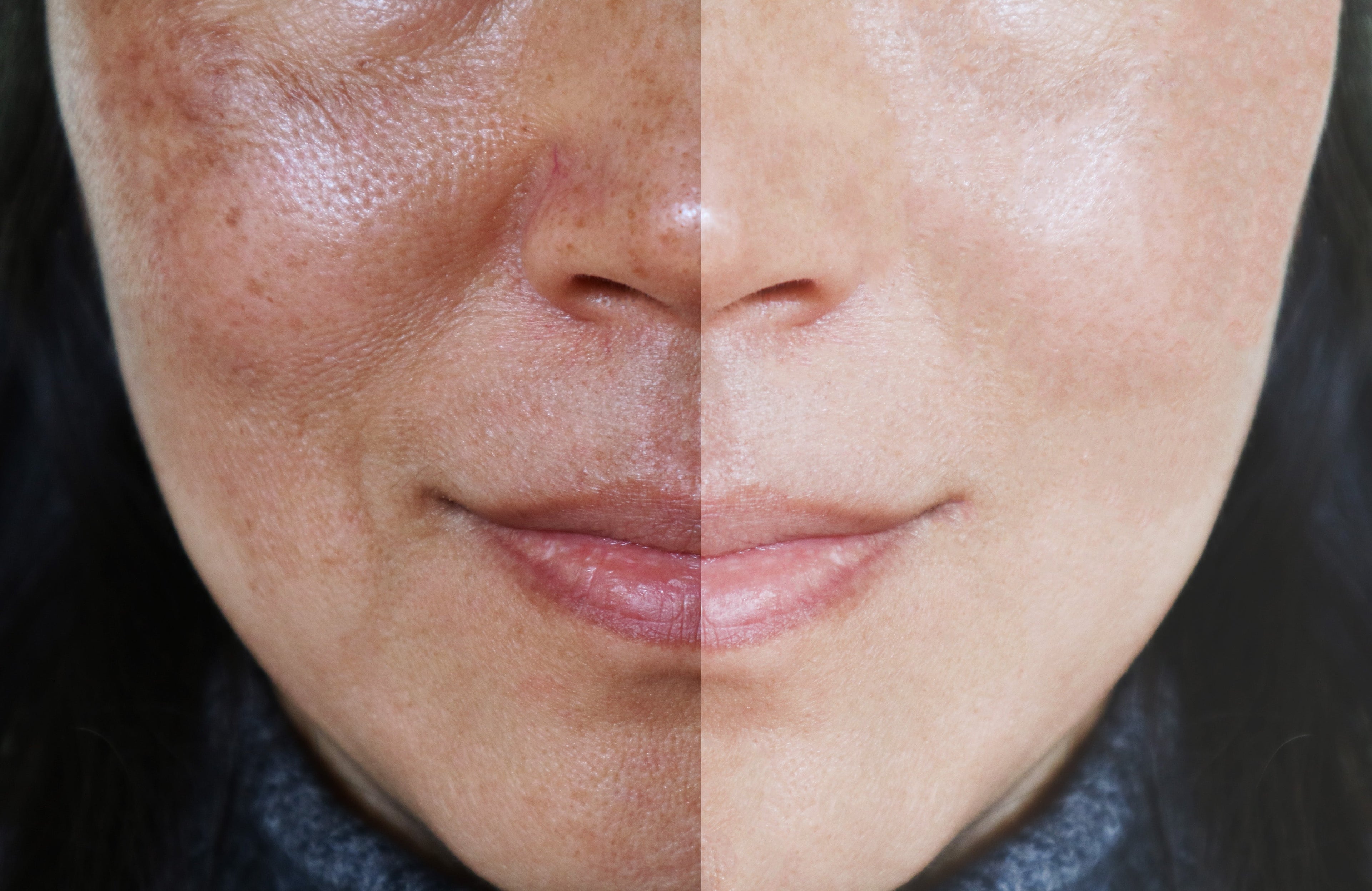Pigmentation, Melasma & Uneven Skin Tone: A Holistic Approach to Skin Health