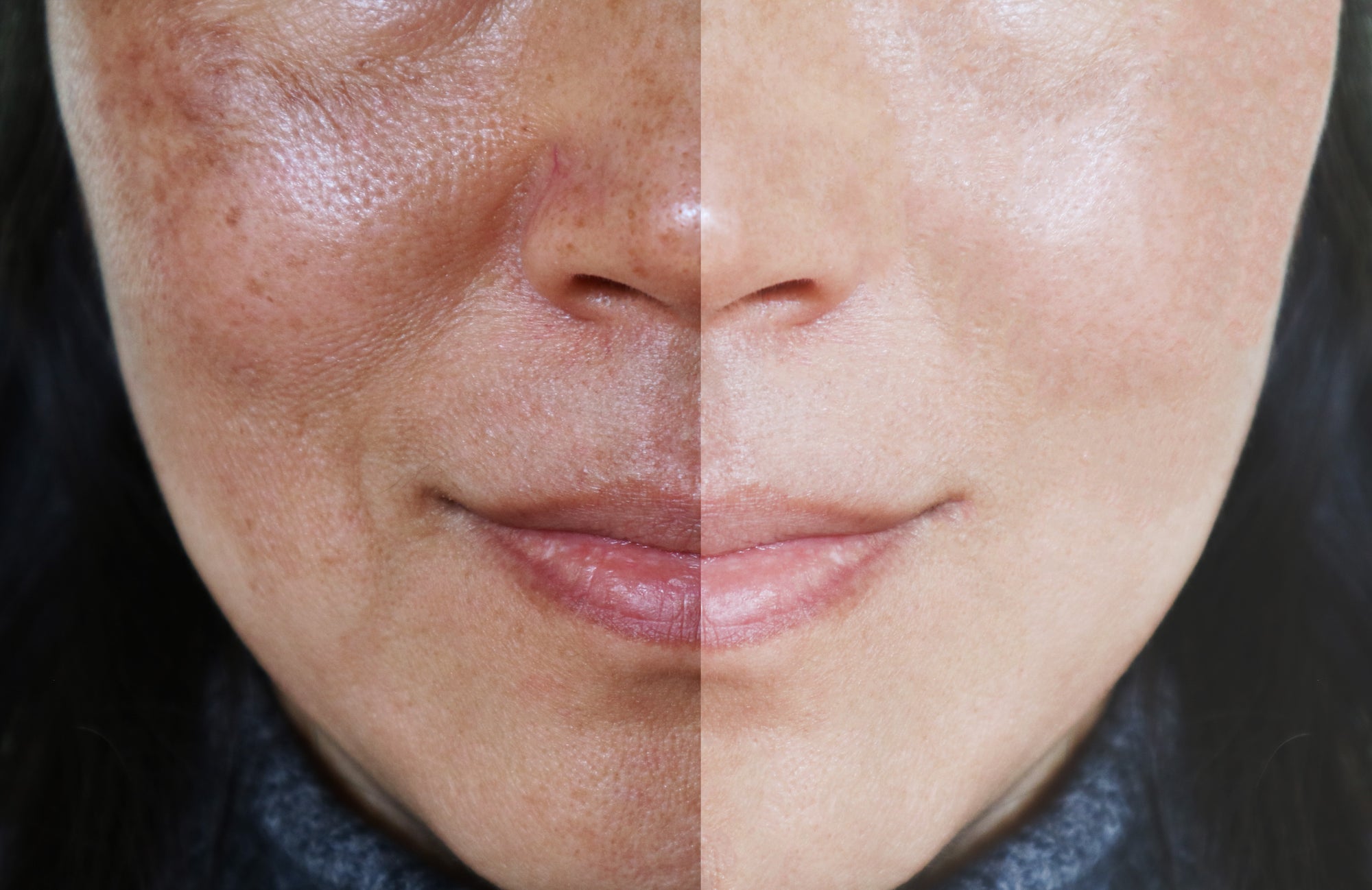 3 Ways to Effectively Lighten Age Spots