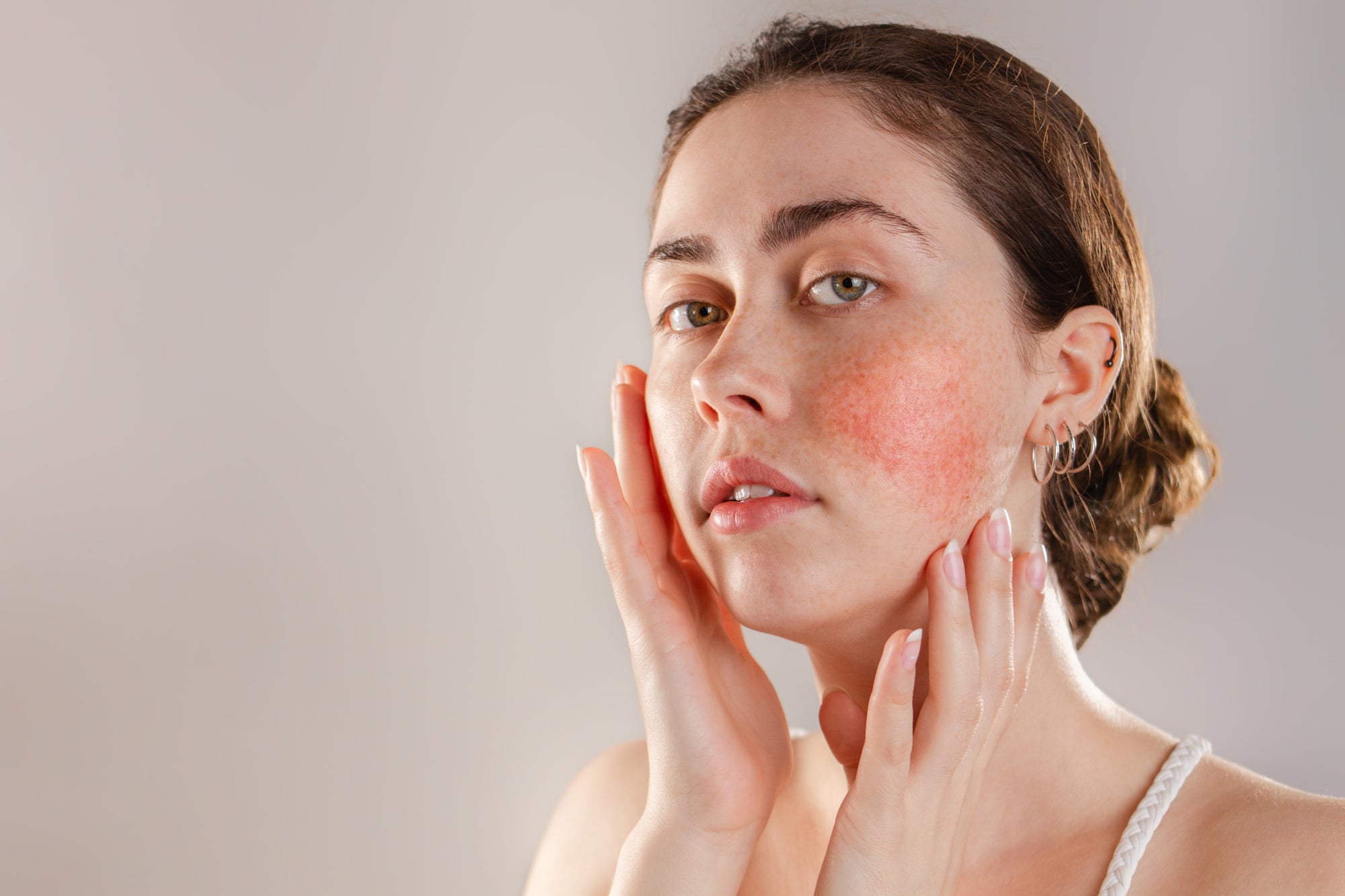 Natural solutions for Rosacea