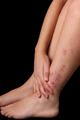 Why must Guttate Psoriasis be treated differently to other forms of psoriasis?