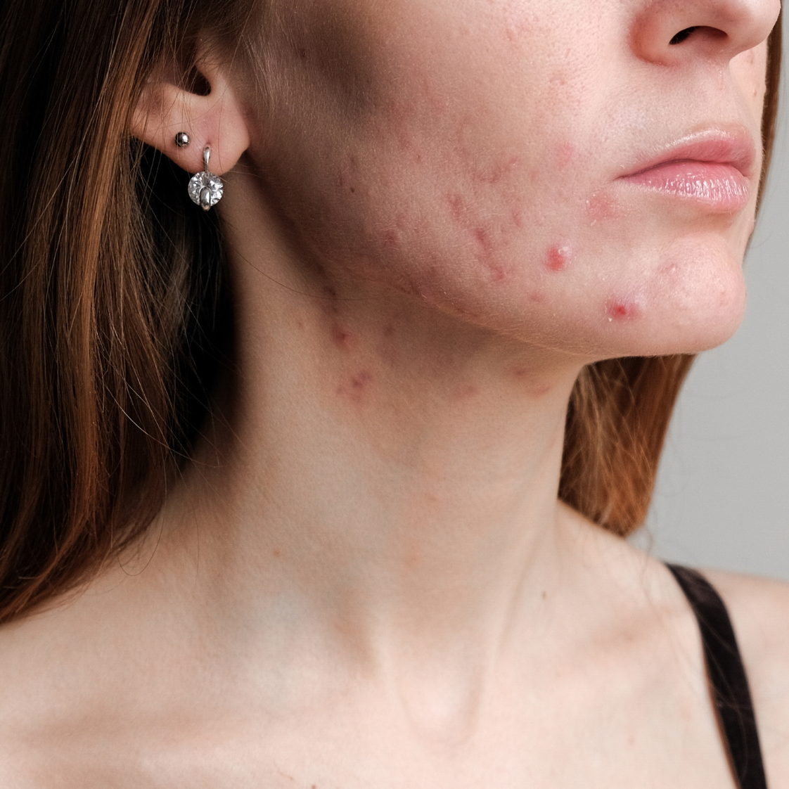 Acne Treatment Guide: Natural Acne Solutions, Hormonal Acne Support & Skin Barrier Repair with Salubre Cosmeceuticals