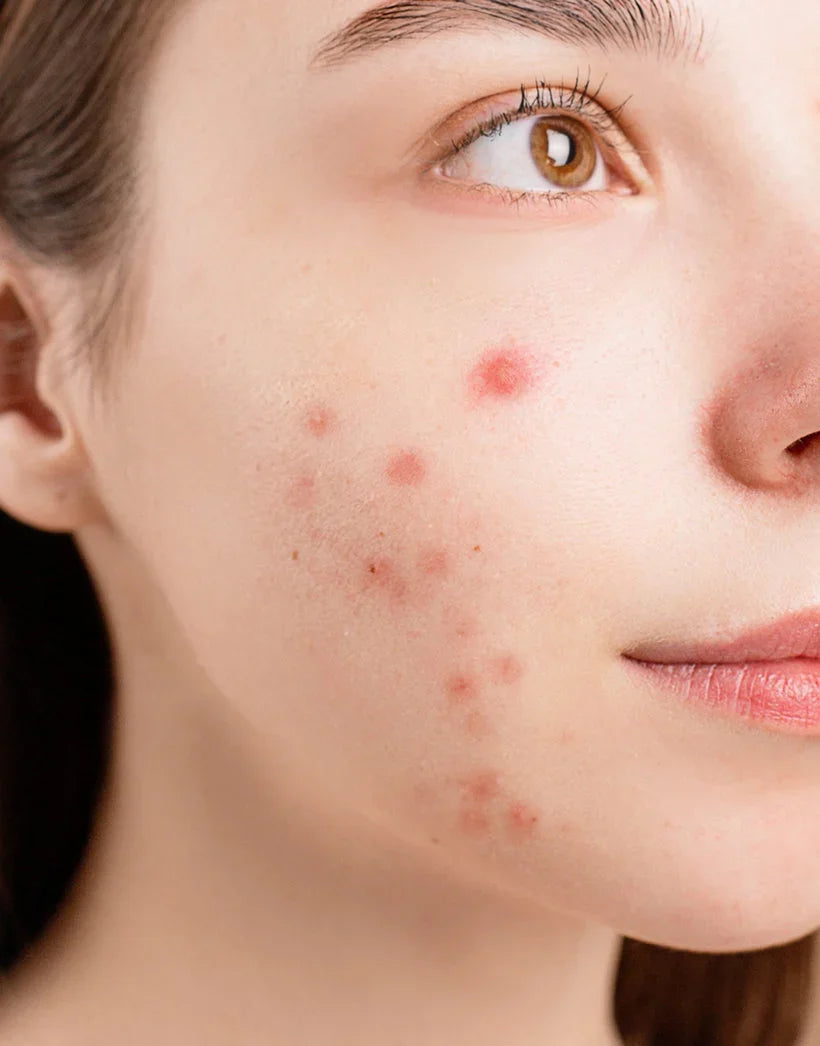 Acne-Prone Skin Solutions