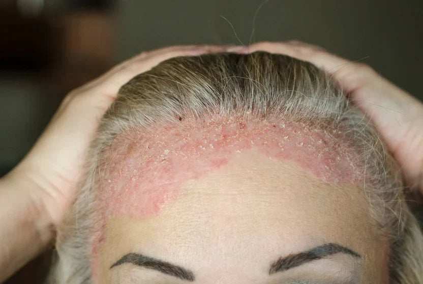 Scalp Psoriasis Support Protocol