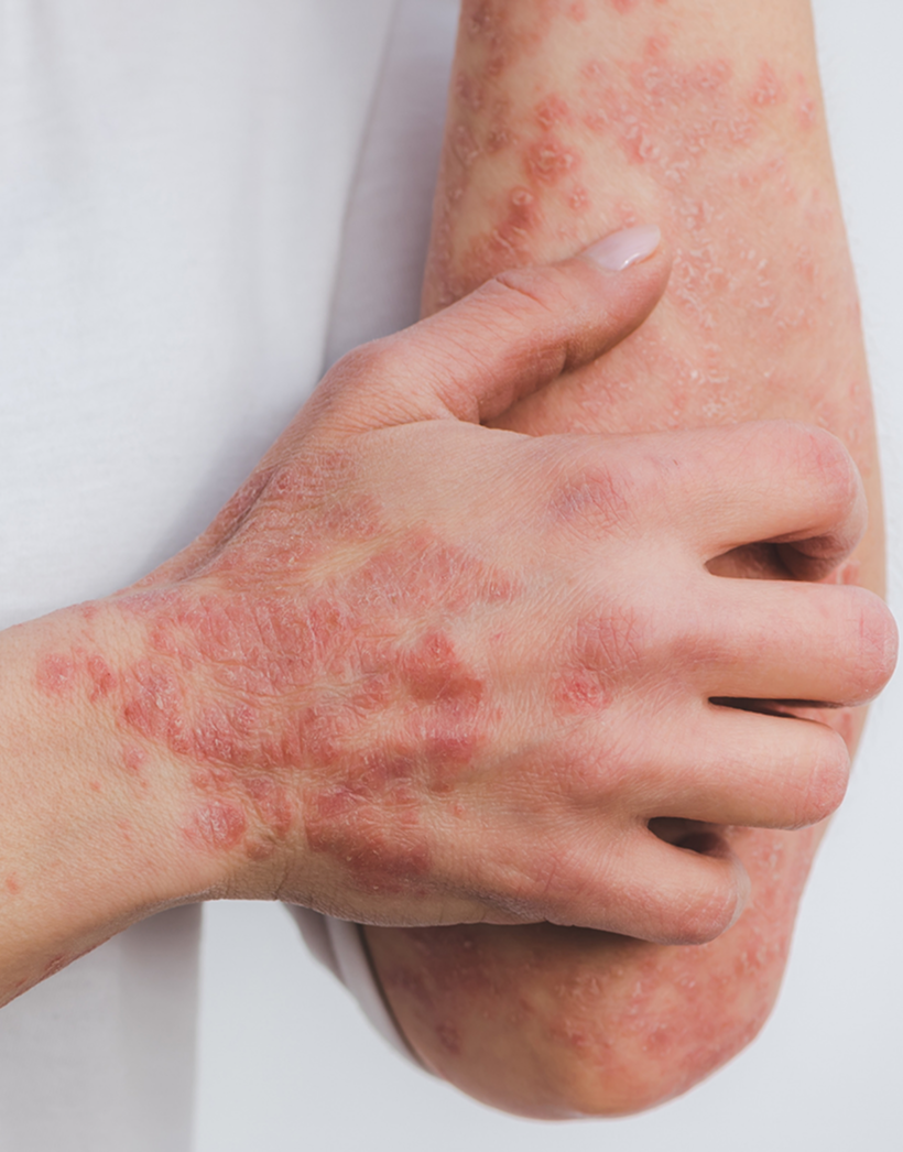 Eczema & Psoriasis