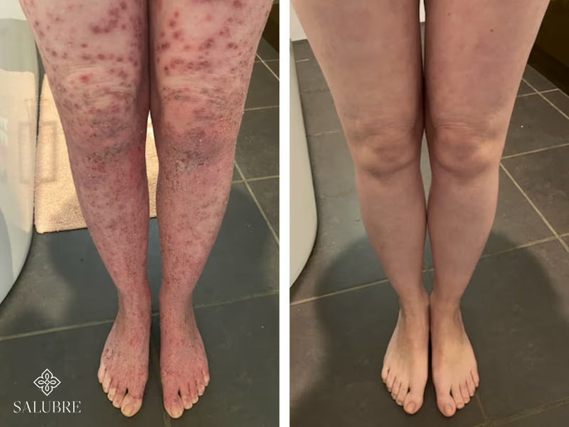 psoriasis before after 5