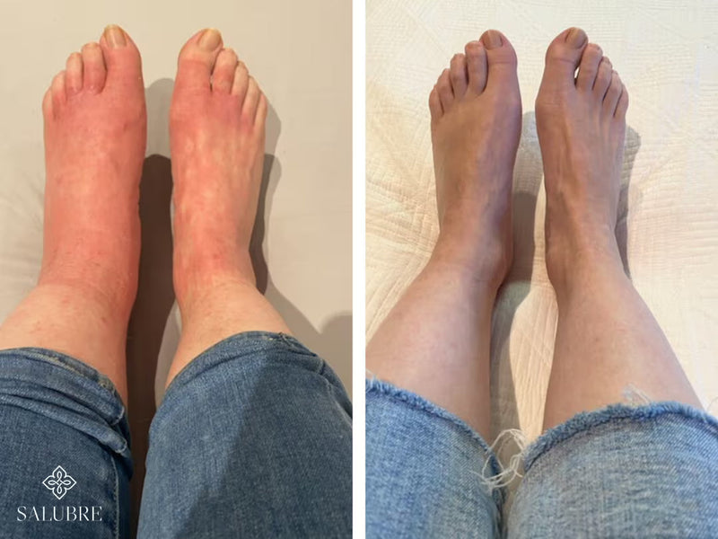 psoriasis before after 4