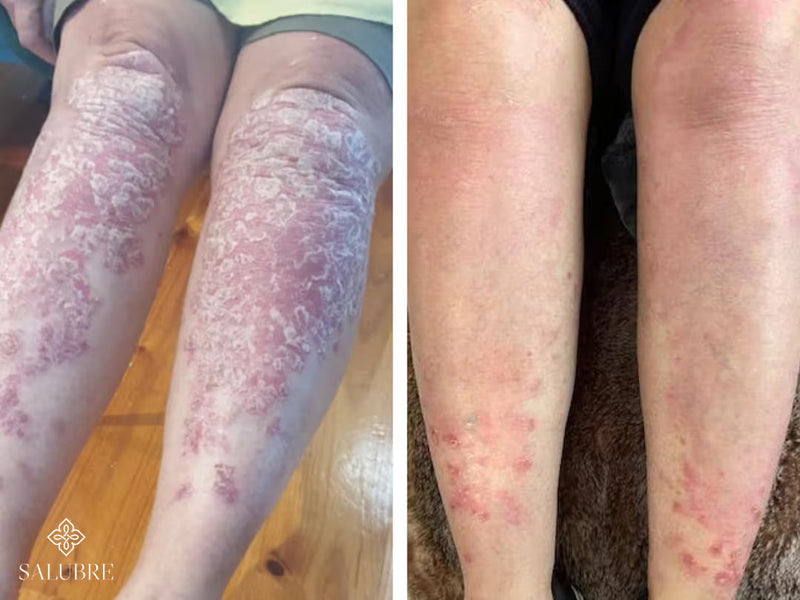 psoriasis before after 7