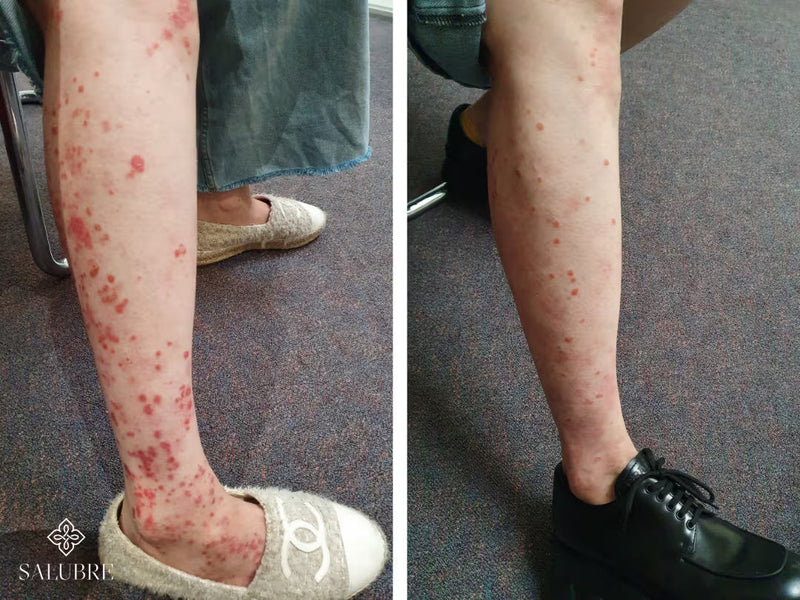 psoriasis before after 1