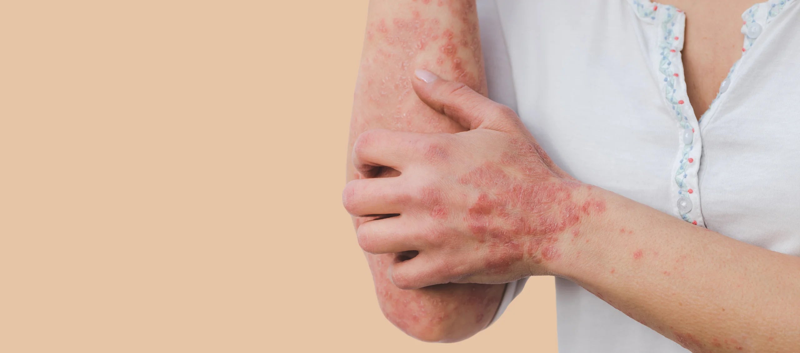 Psoriasis Support