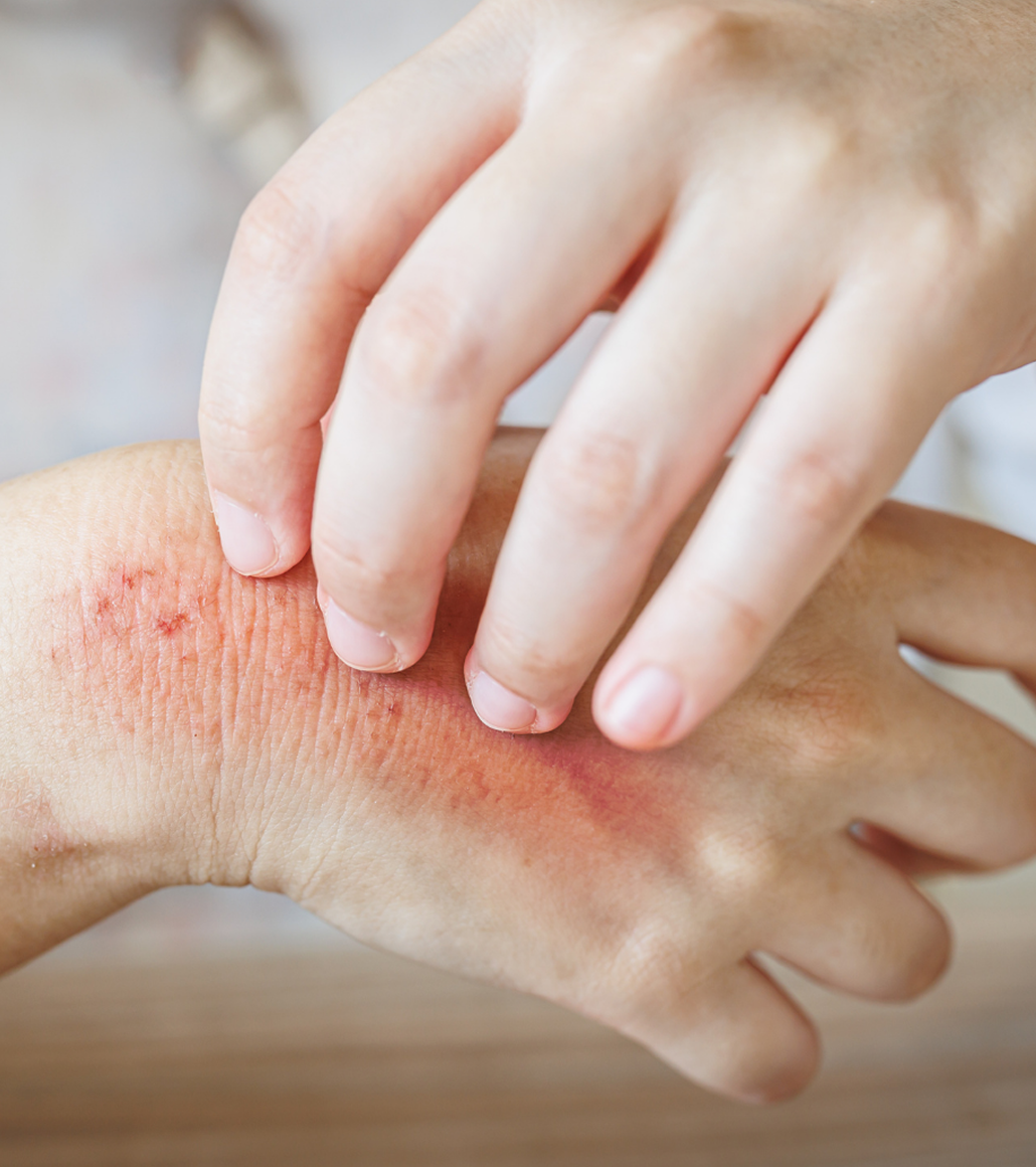 Chronic Eczema