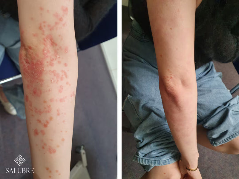 psoriasis before after 9