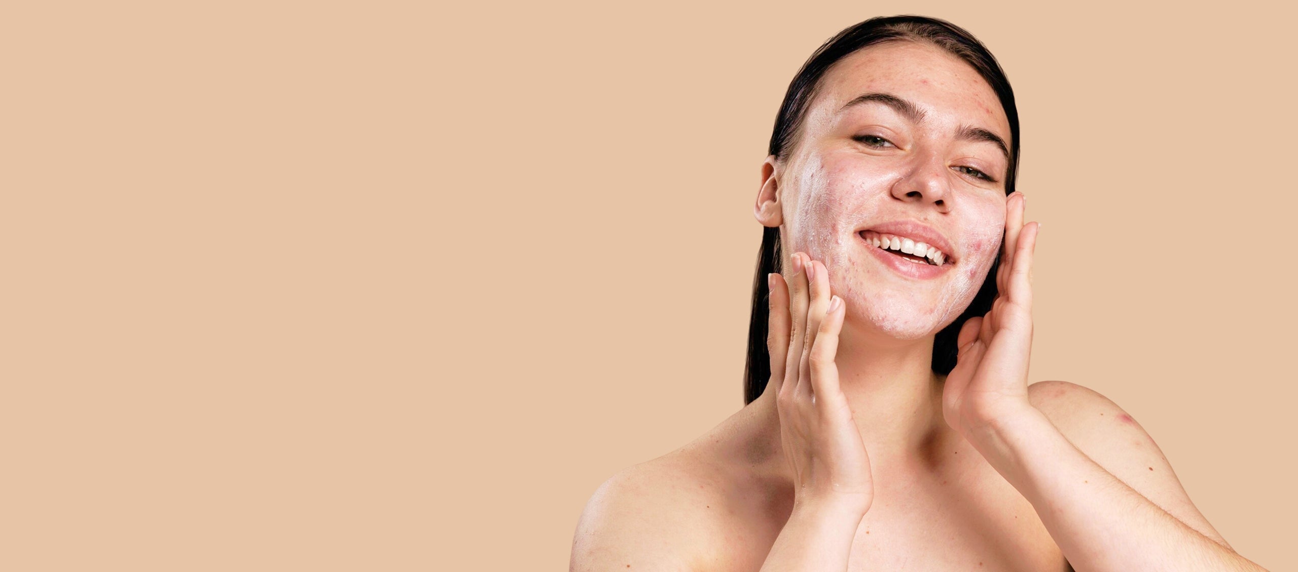 Acne-FAQ_s-banner
