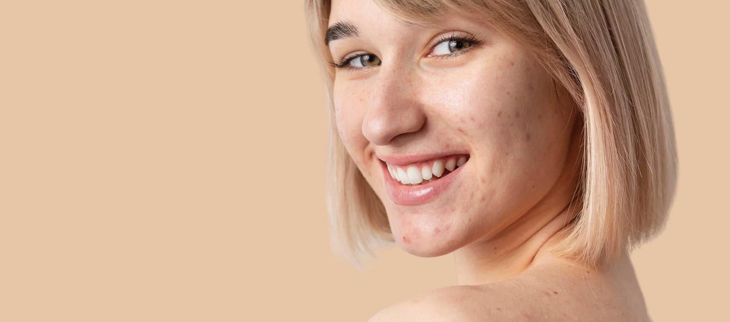 Acne Treatment