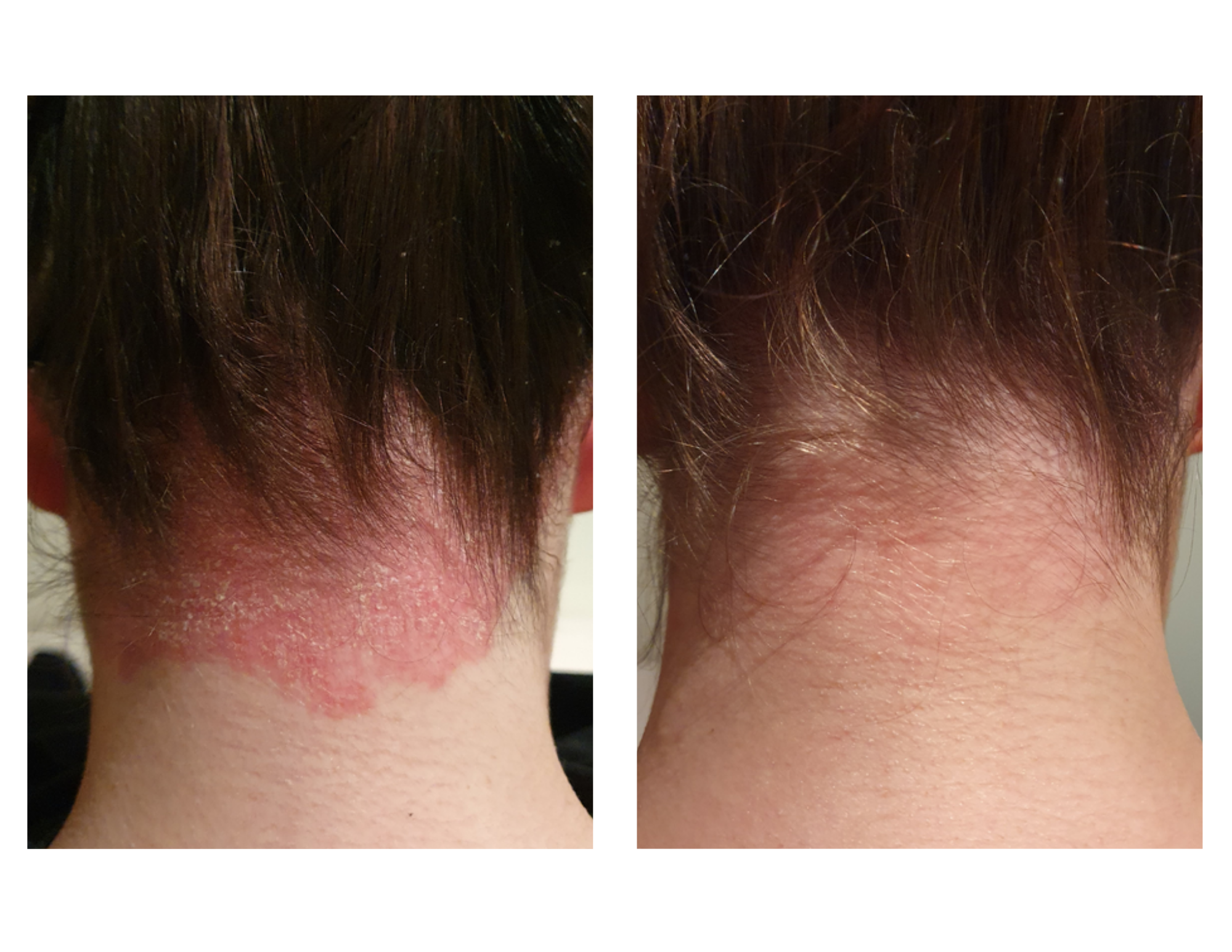 Psoriasis Support