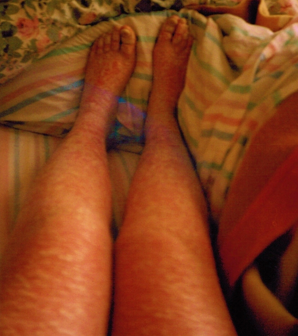 My Skin Story
