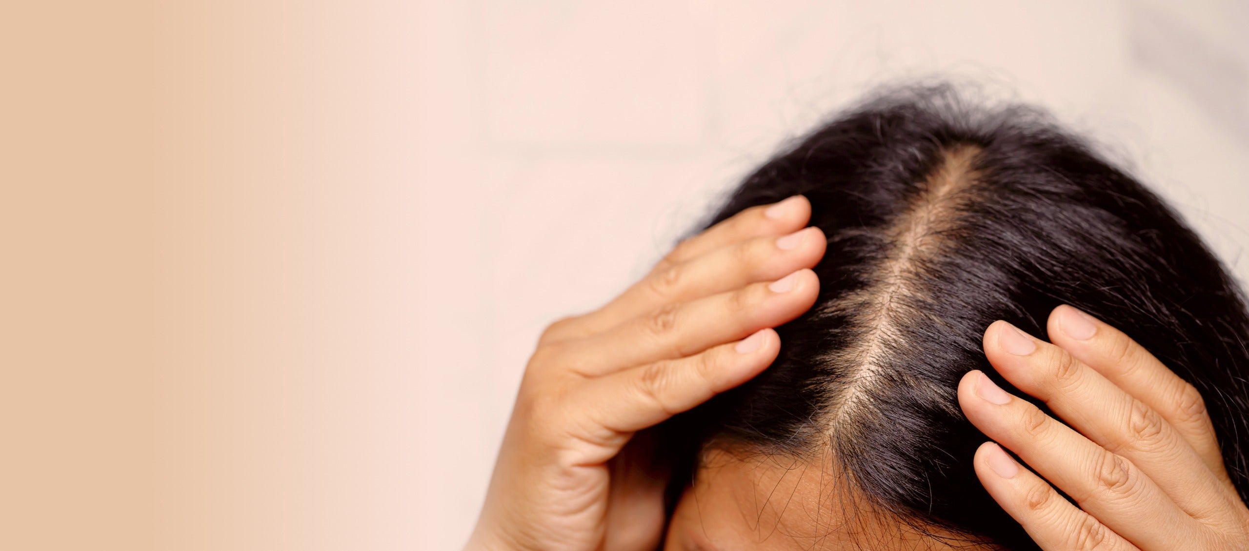 Scalp Psoriasis