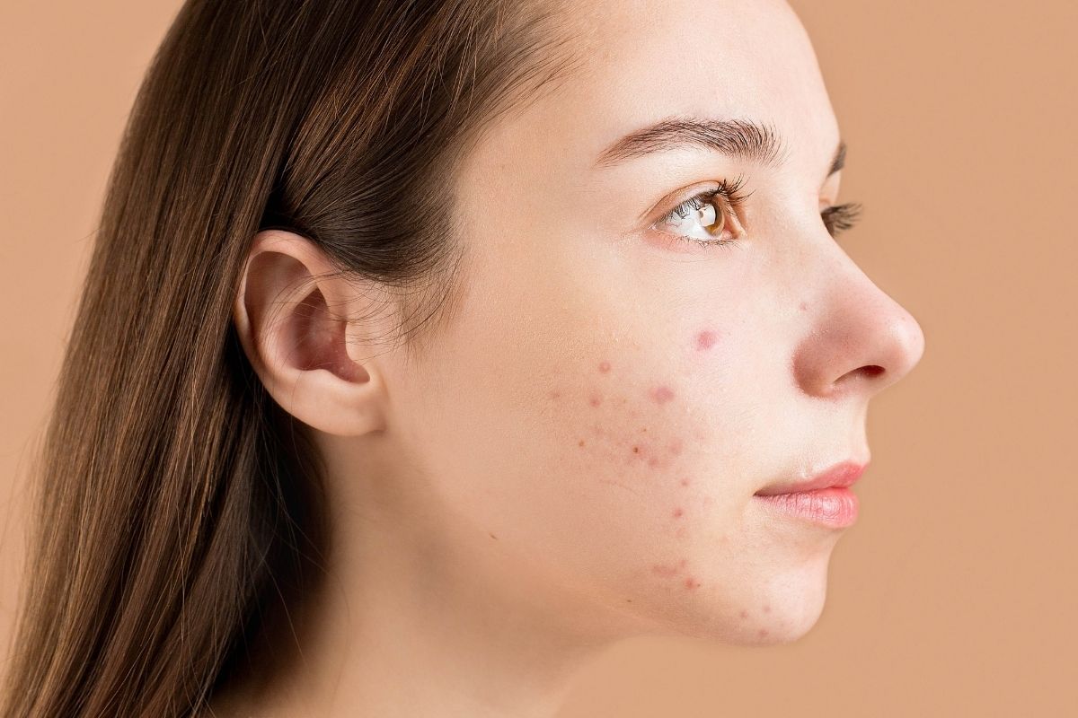 Acne skin care solutions and frequently asked questions