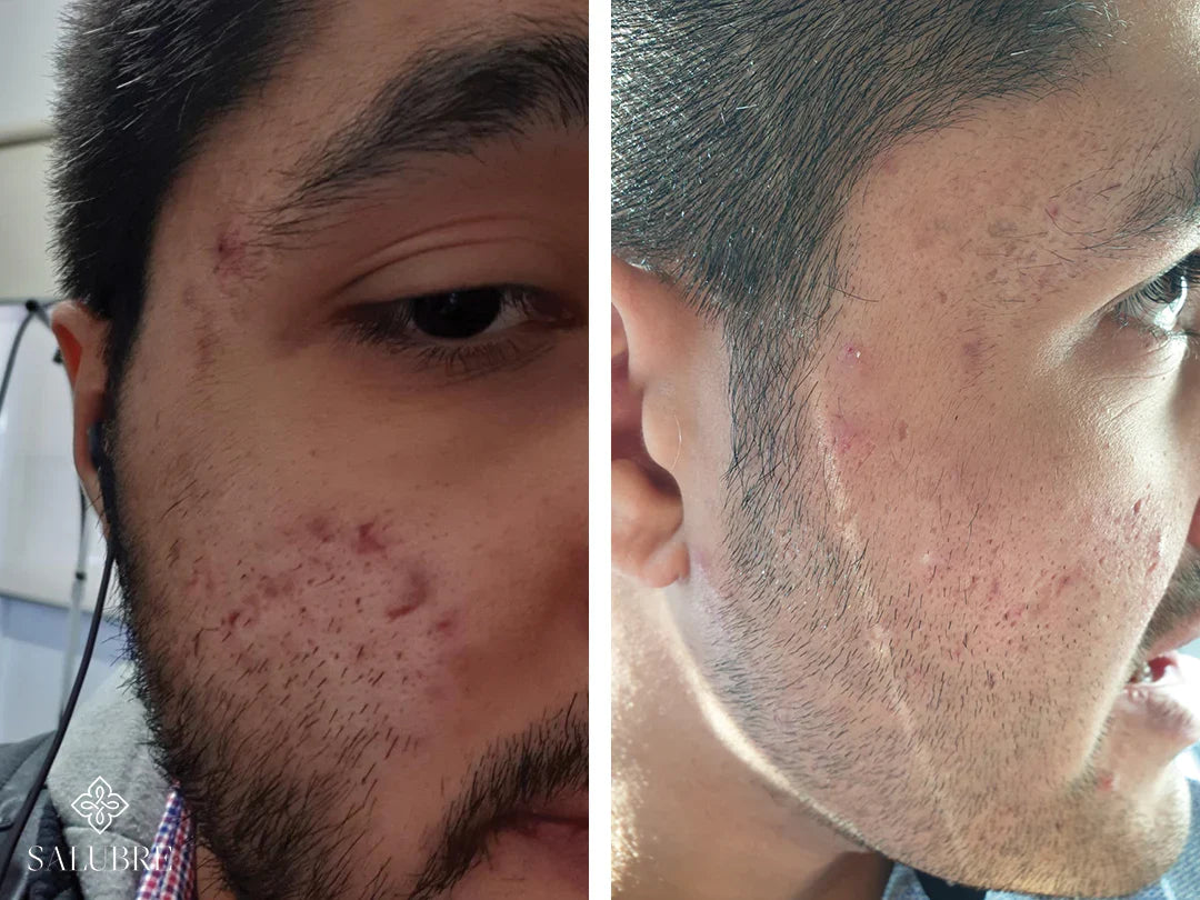 acne-before-and-after