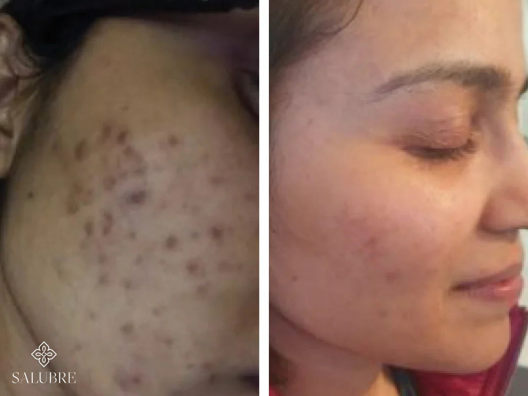 acne-skincare-results