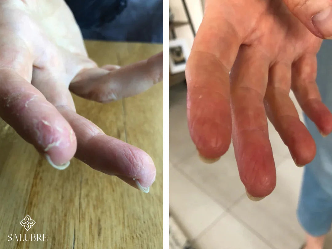 dermatitis-on-hands-before-and-after