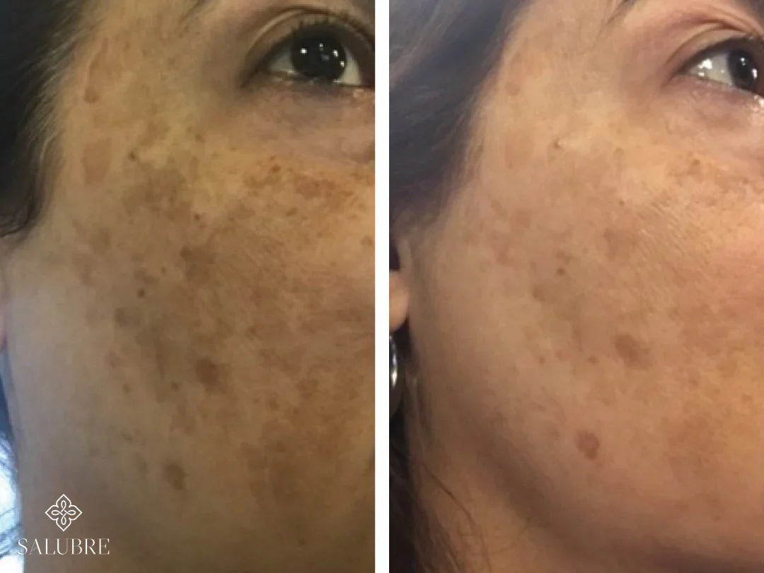 facial-melasma-before-and-after