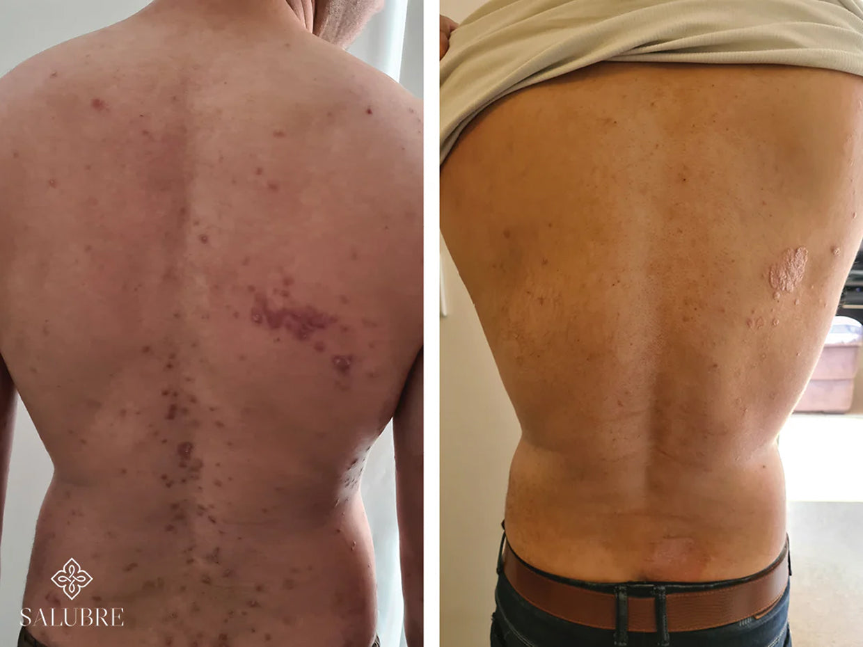 guttate-psoriasis