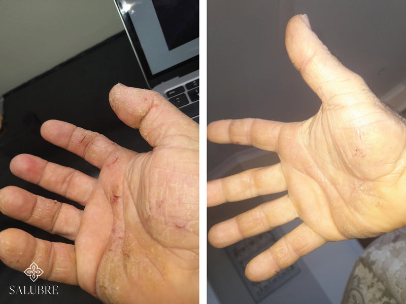 psoriasis before after 8