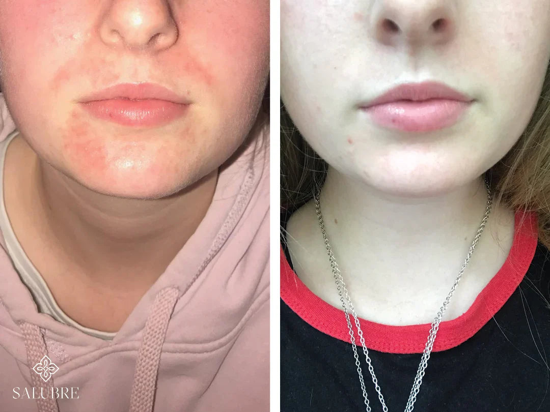 perioral-dermititis-before-and-after