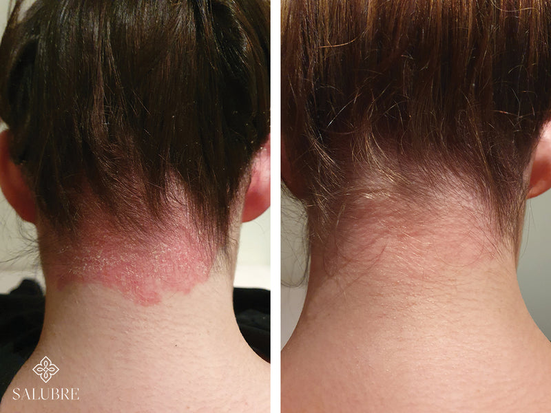 psoriasis before after 10