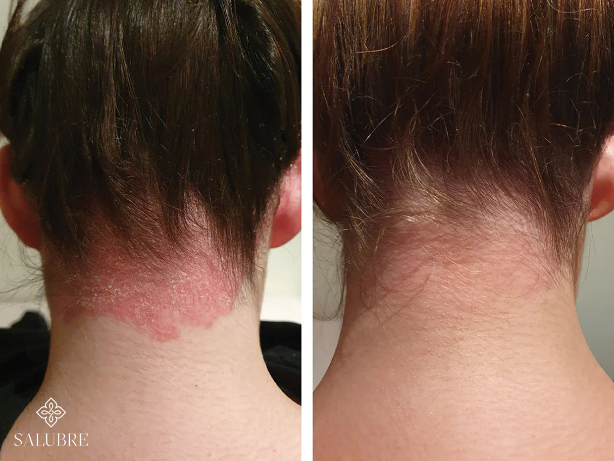 plaque-psoriasis