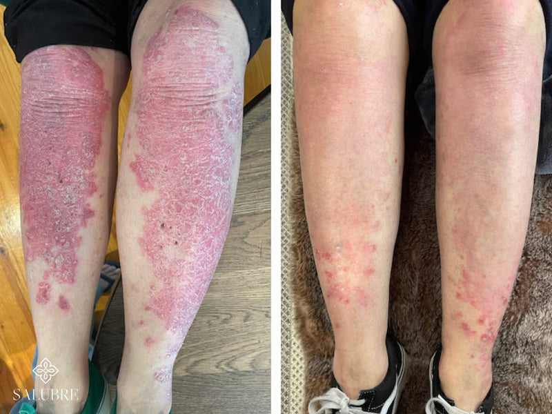 psoriasis before after 2