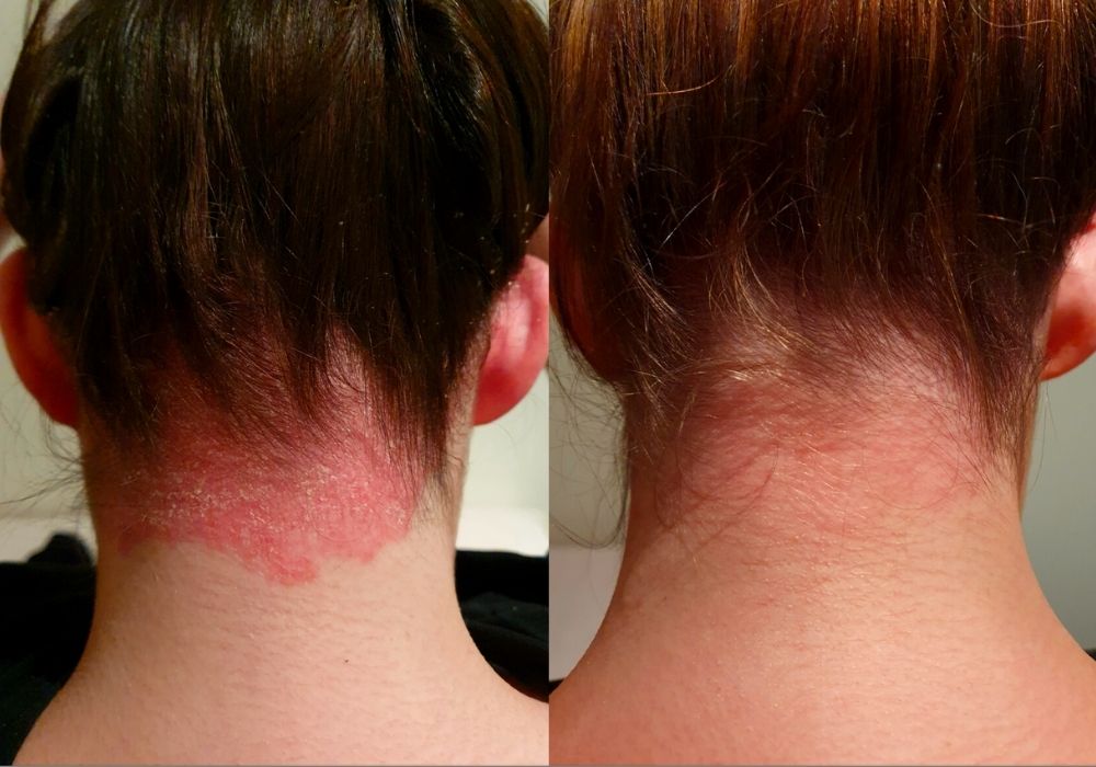Psoriasis rash before and after treatment