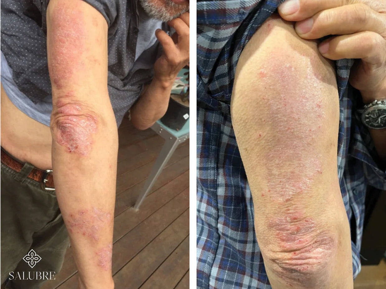 psoriasis-before-and-after
