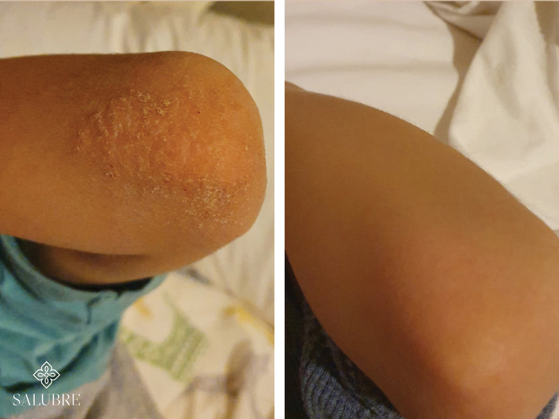 psoriasis before after 6