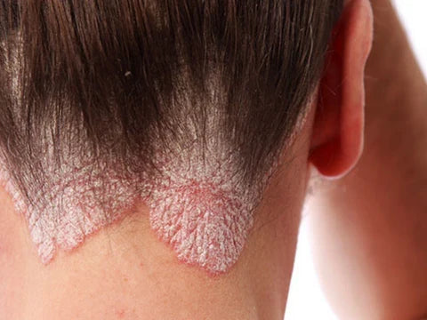 psoriasis-treatment-management
